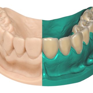Dental Prosthesis