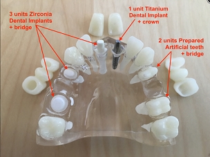 Upper Clear Model with Rooted Teeth